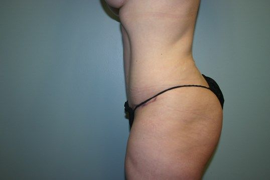 Body Contouring Before & After
