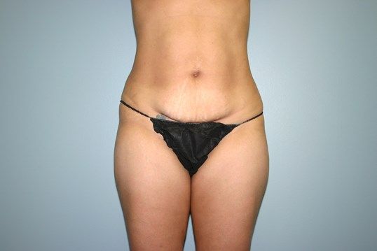 Body Contouring Before & After