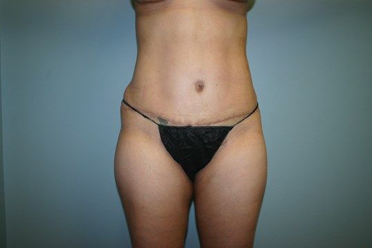Body Contouring Before & After