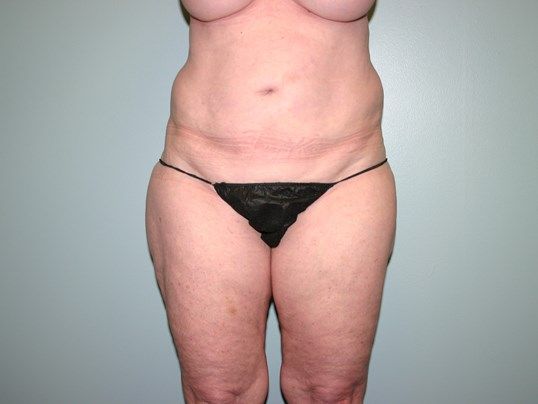 Body Contouring Before & After