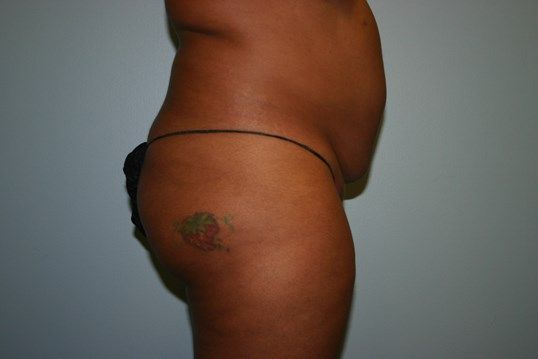 Body Contouring Before & After