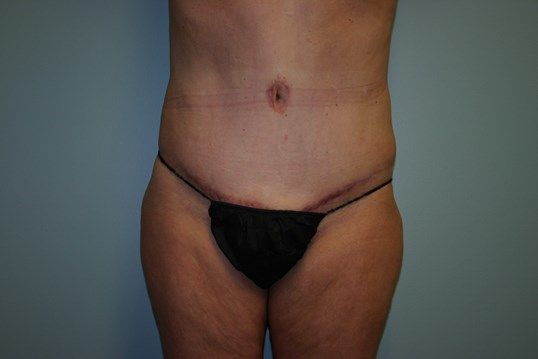 Body Contouring Before & After