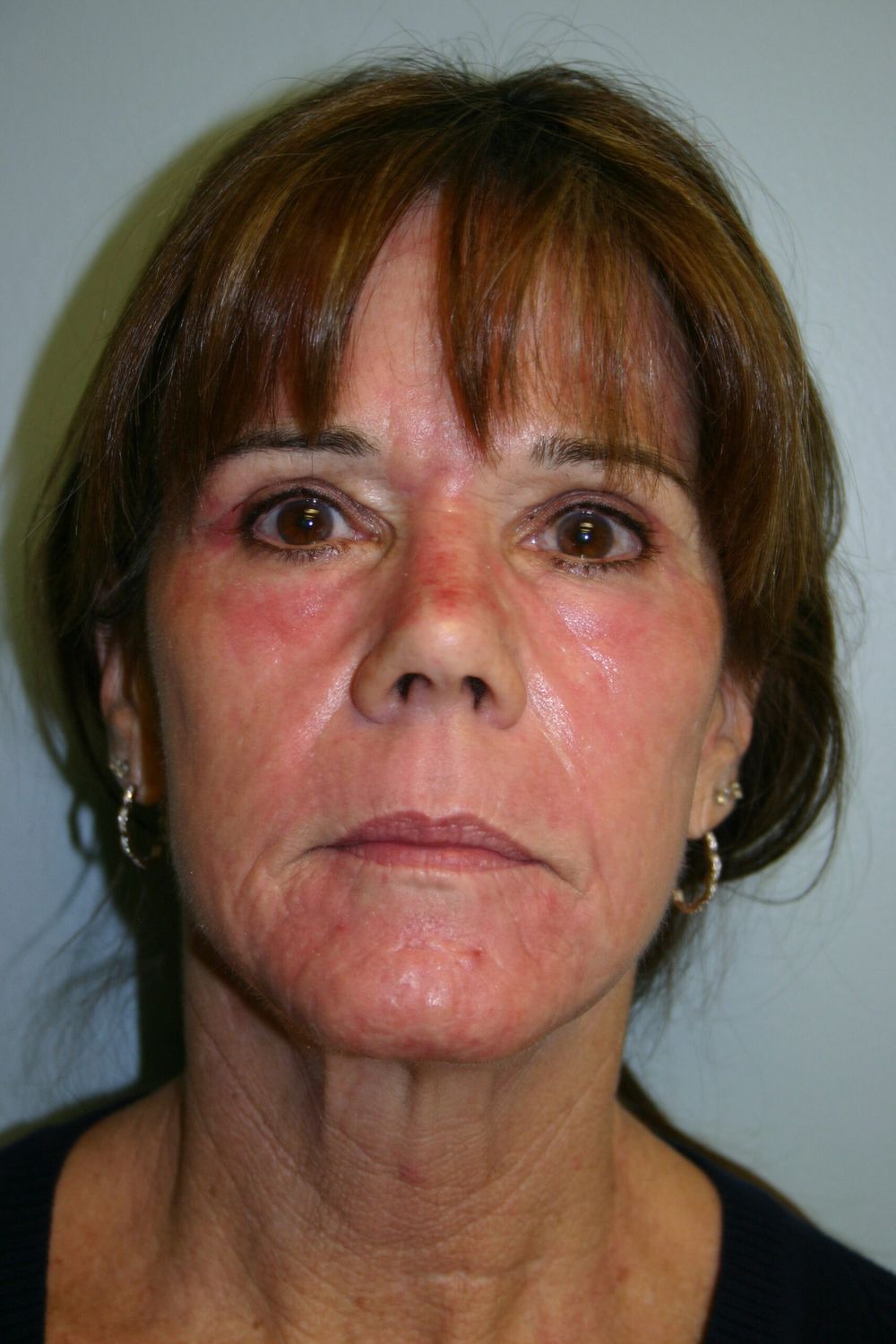 Laser Skin Resurfacing Before & After