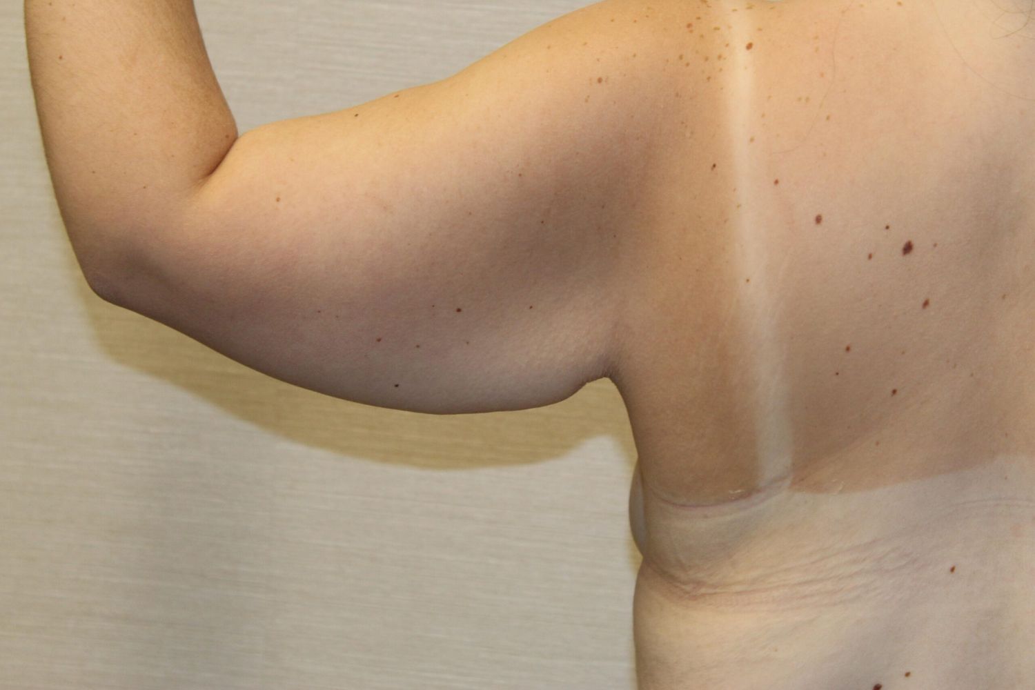 Arm Lift Before & After