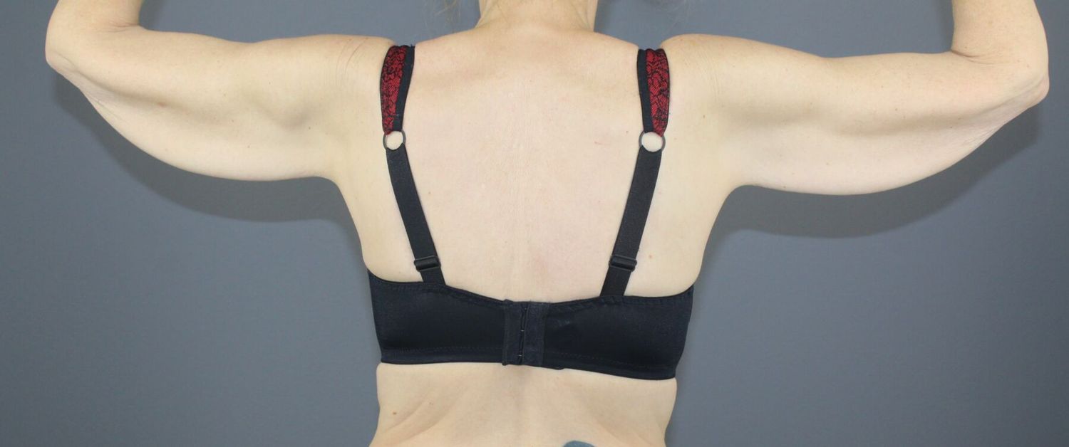 Arm Lift Before & After