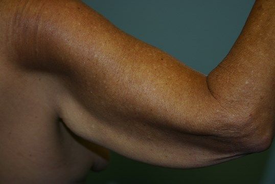 Arm Lift Before & After