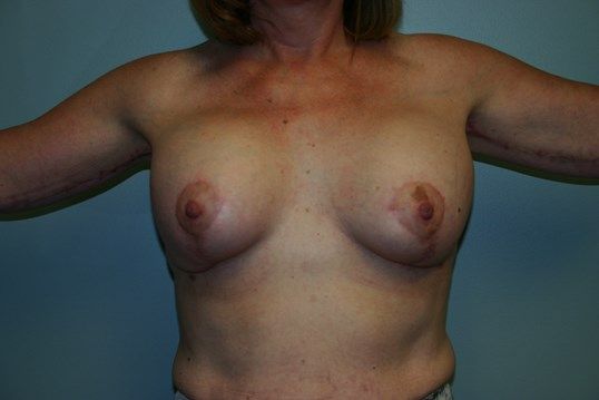 Arm Lift Before & After