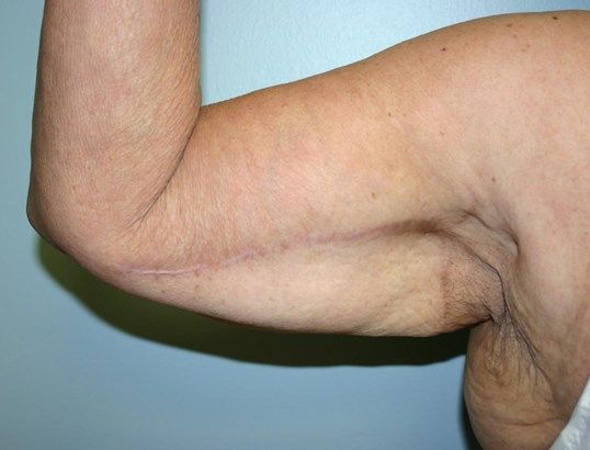 Arm Lift Before & After