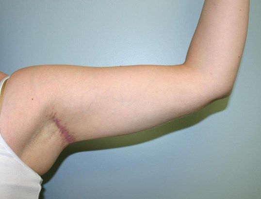 Arm Lift Before & After