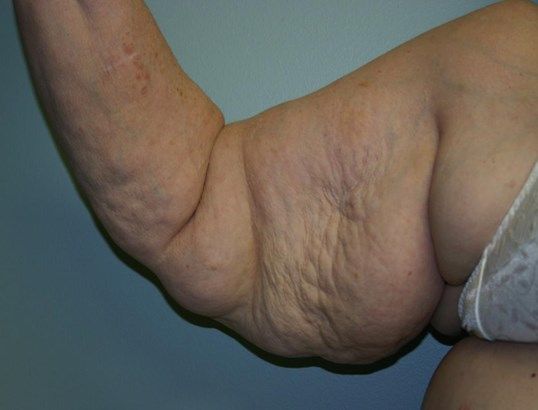 Arm Lift Before & After