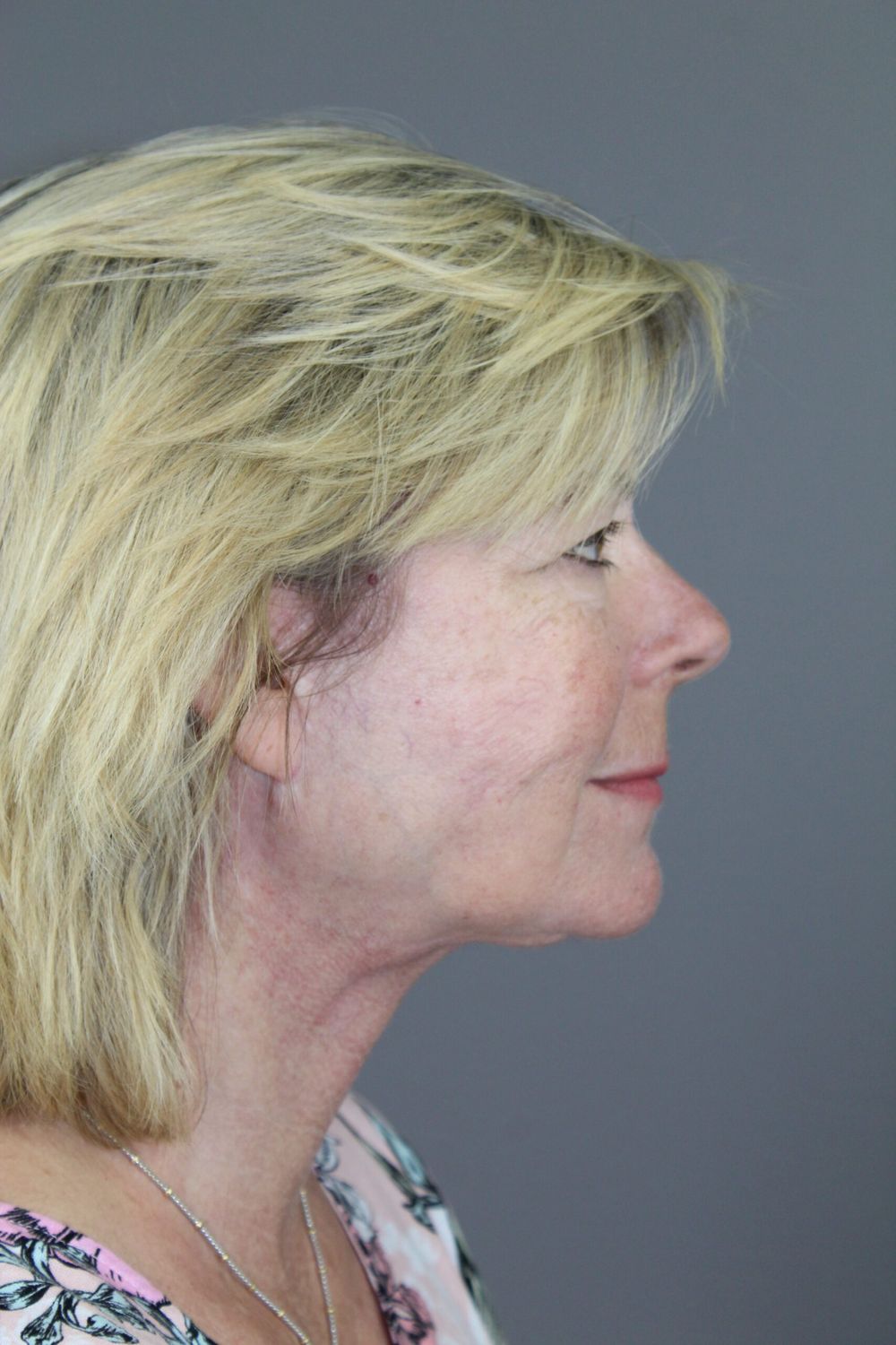 Face Lift Before & After