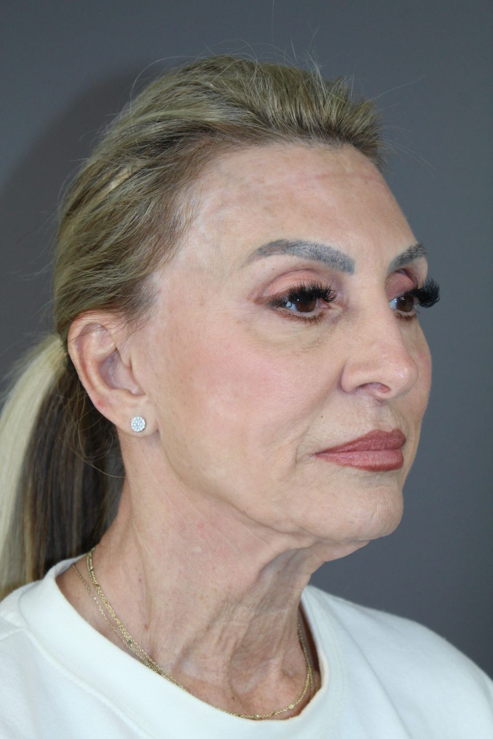 Face Lift Before & After