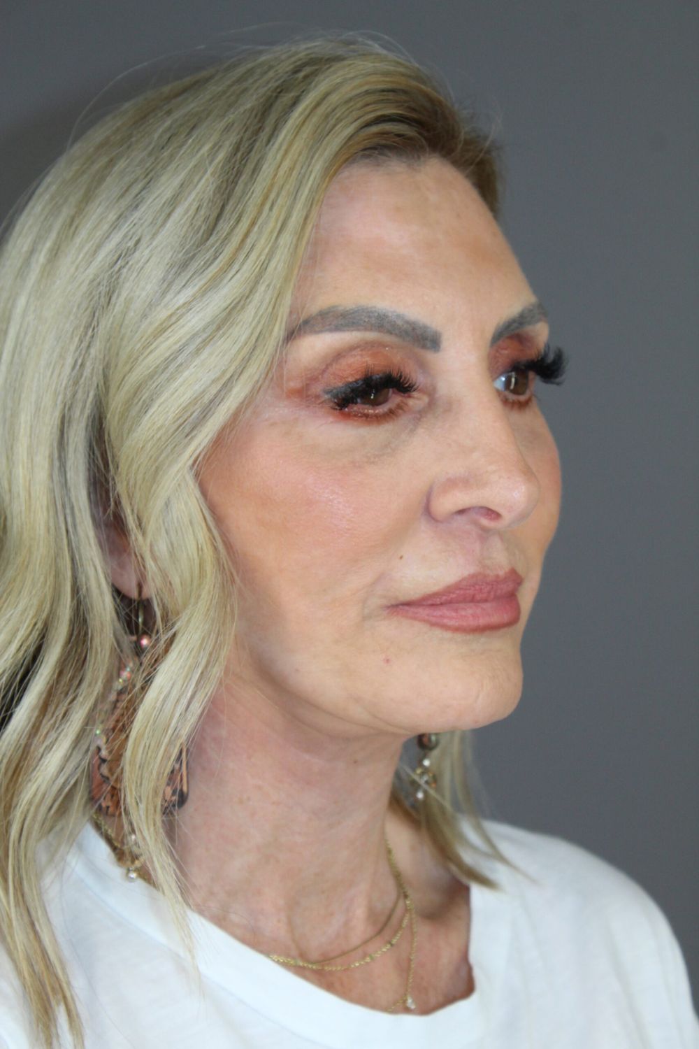 Face Lift Before & After