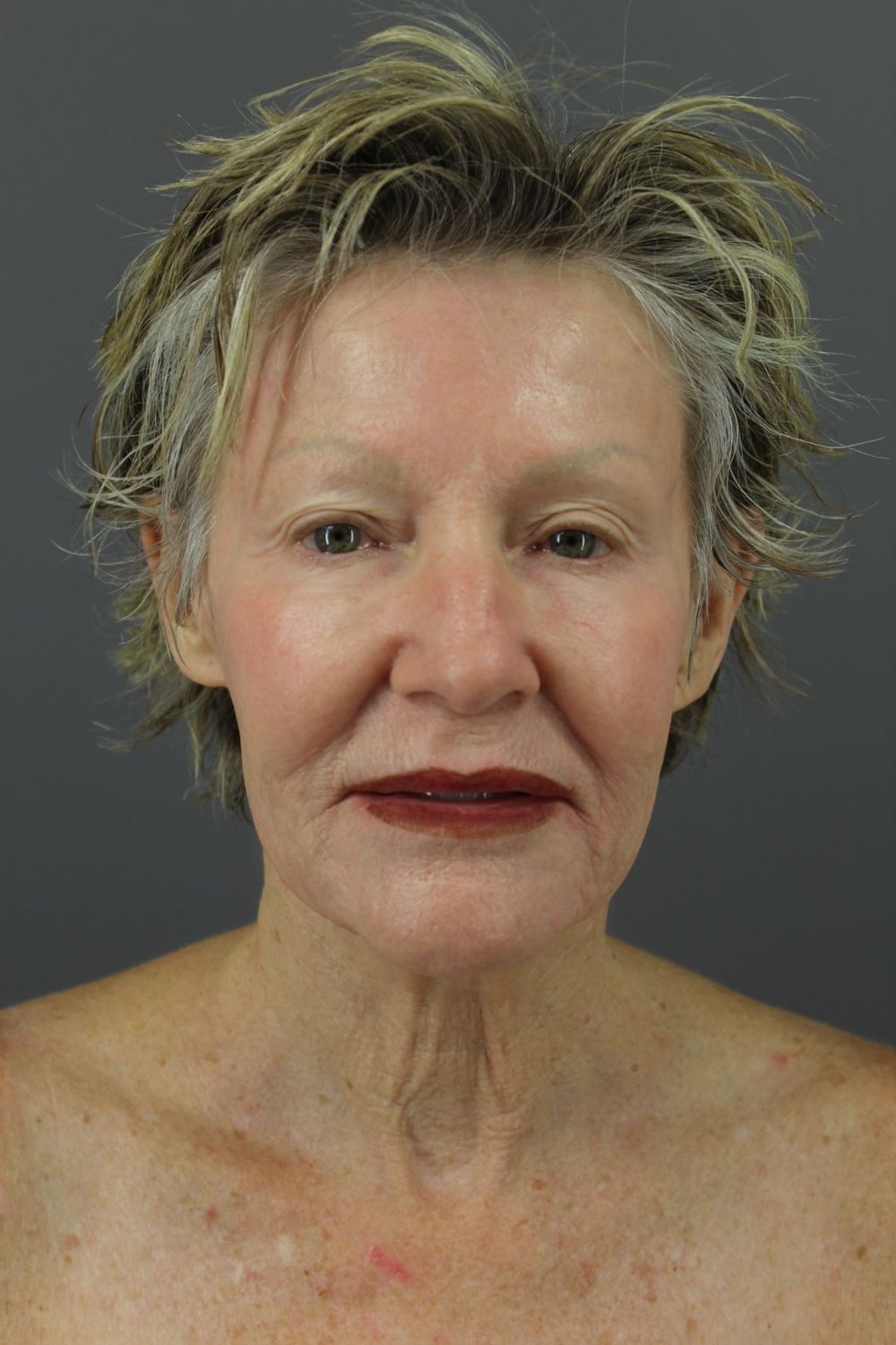 Face Lift Before & After