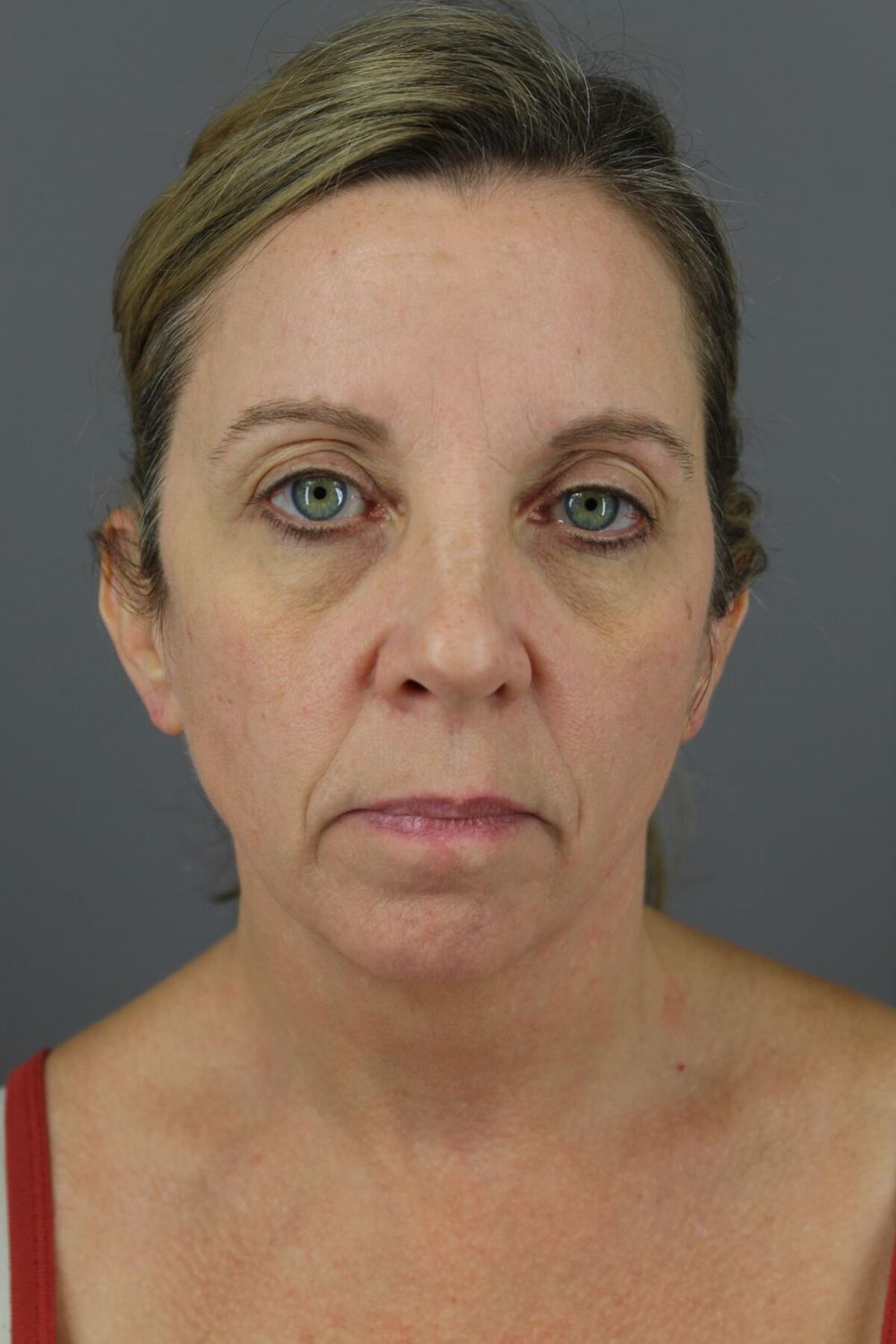 Face Lift Before & After