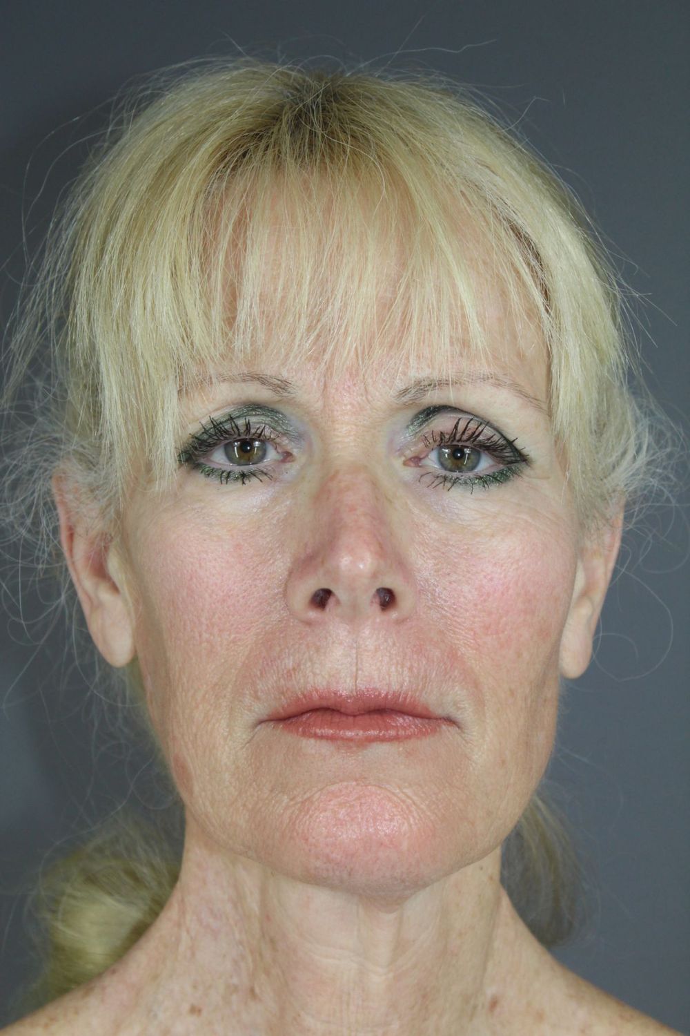 Face Lift Before & After