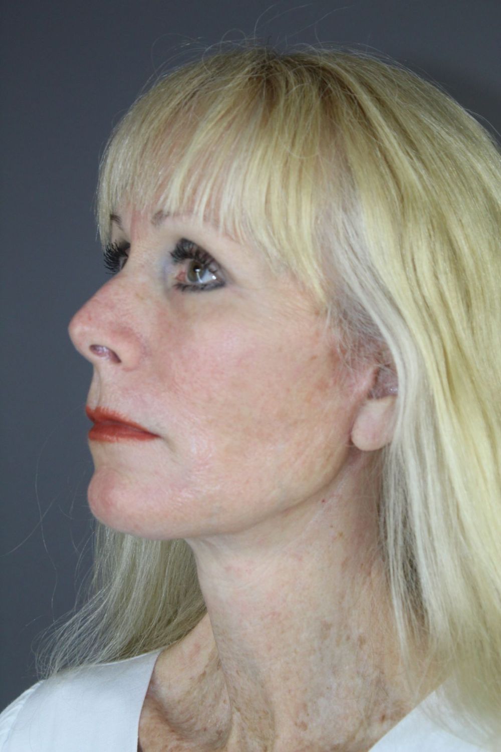 Face Lift Before & After