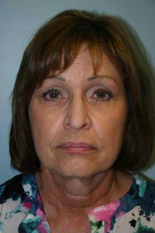 Face Lift Before & After