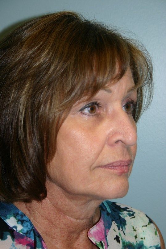 Face Lift Before & After