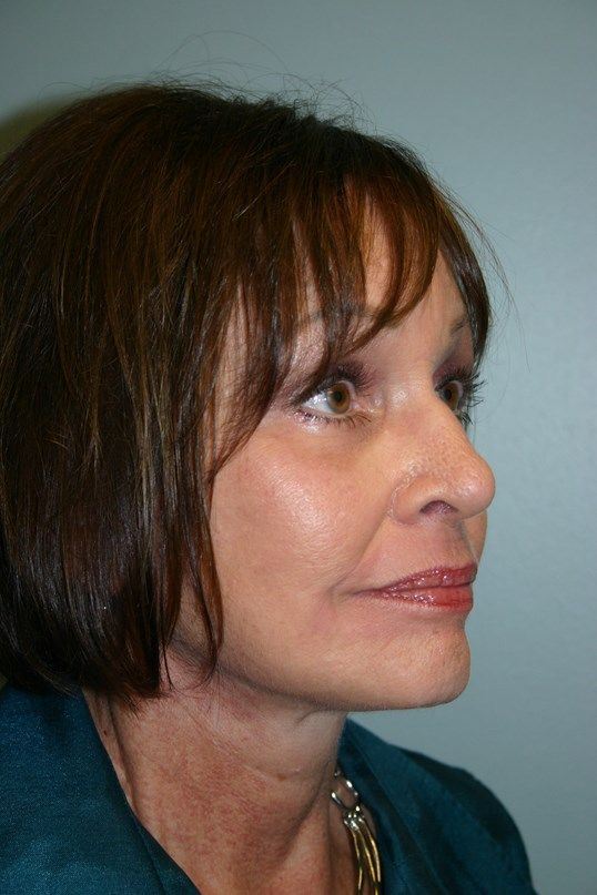 Face Lift Before & After