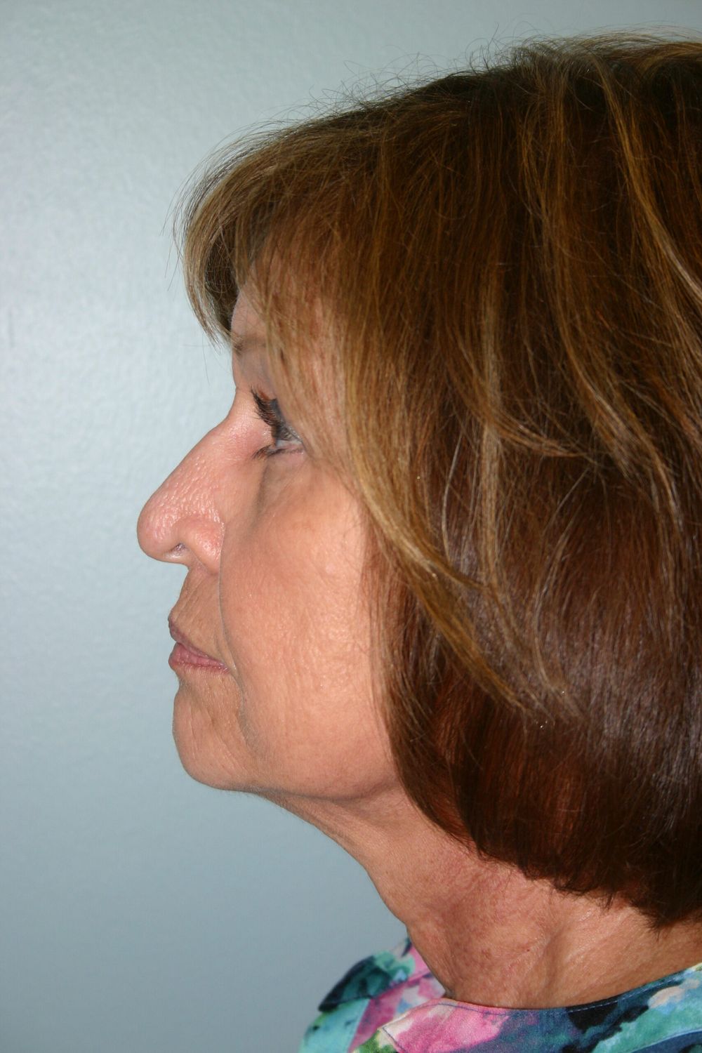 Face Lift Before & After