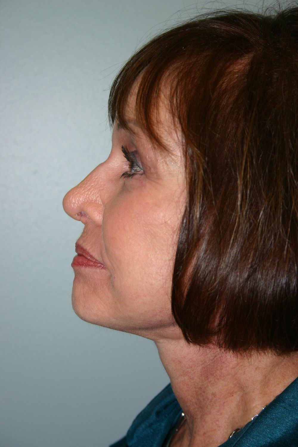 Face Lift Before & After