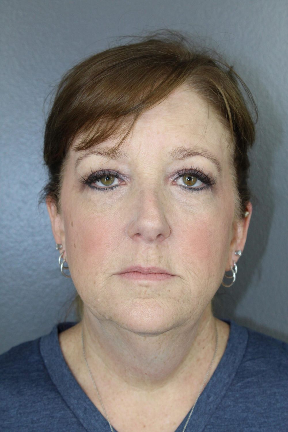 Face Lift Before & After