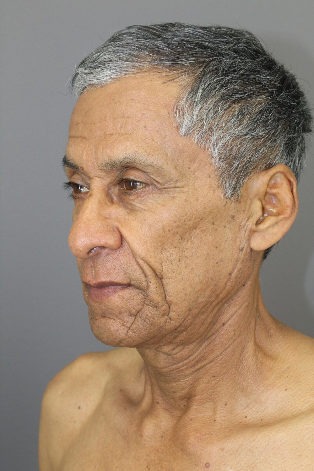 Face Lift Before & After