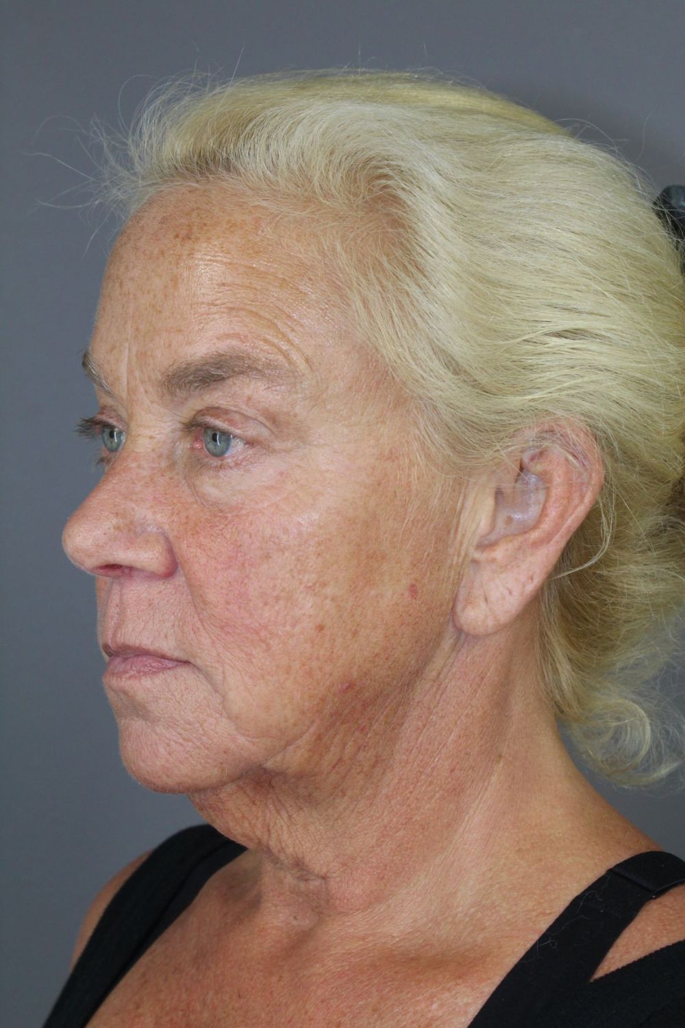 Face Lift Before & After