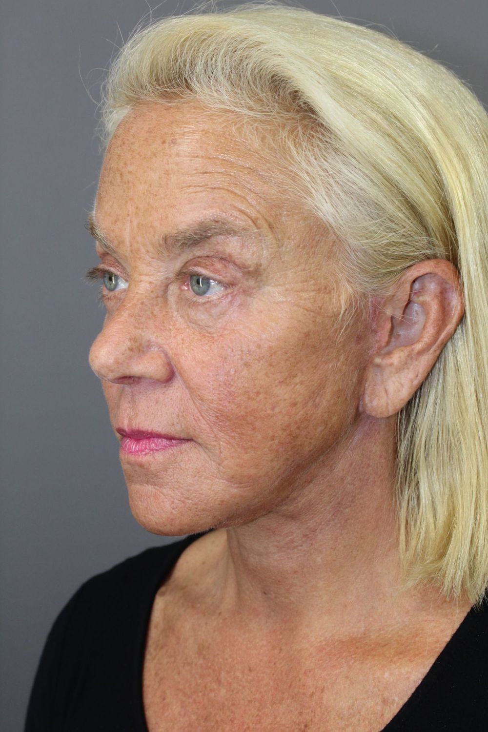 Face Lift Before & After