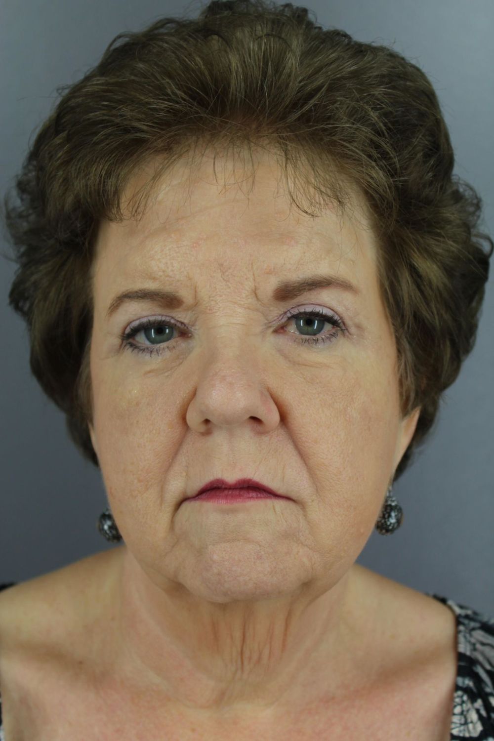 Face Lift Before & After