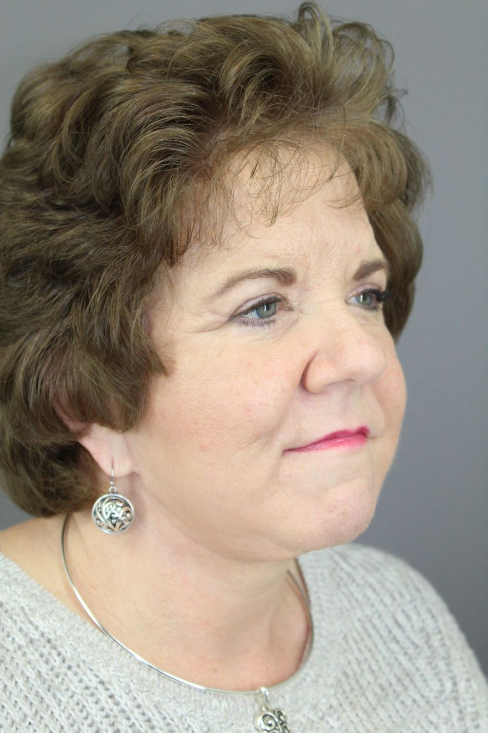 Face Lift Before & After