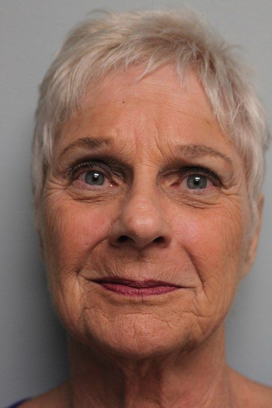 Face Lift Before & After