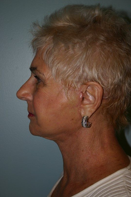 Face Lift Before & After