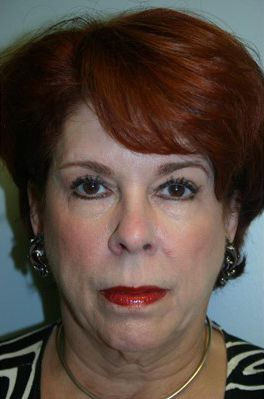 Face Lift Before & After