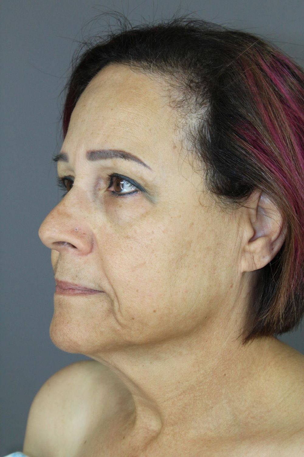 Face Lift Before & After
