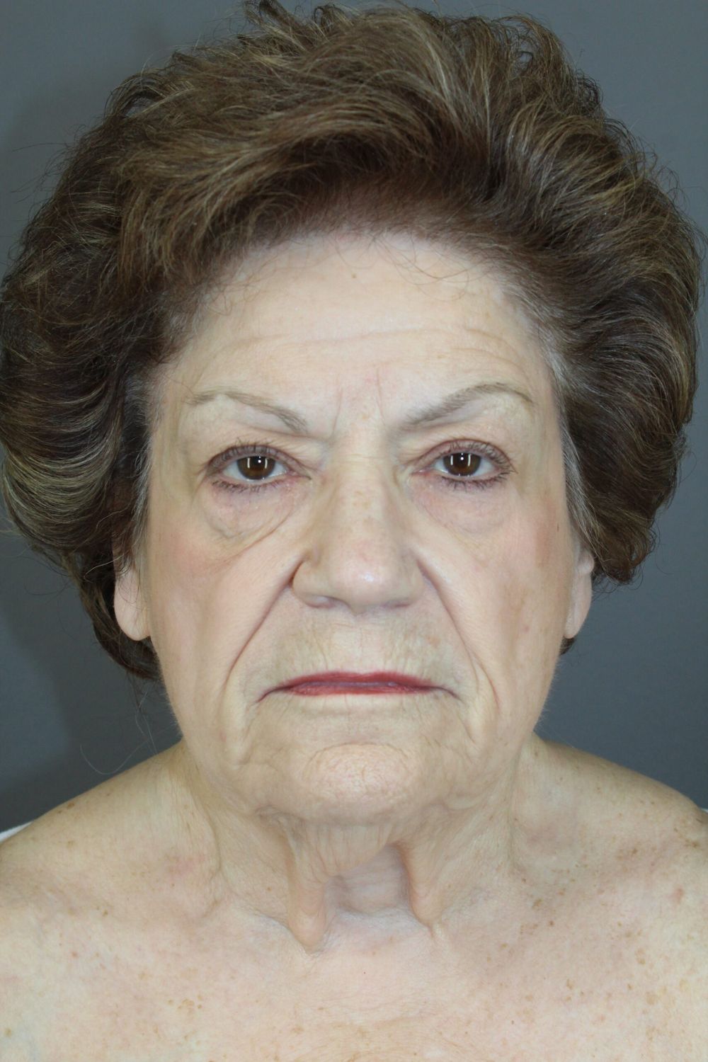 Face Lift Before & After