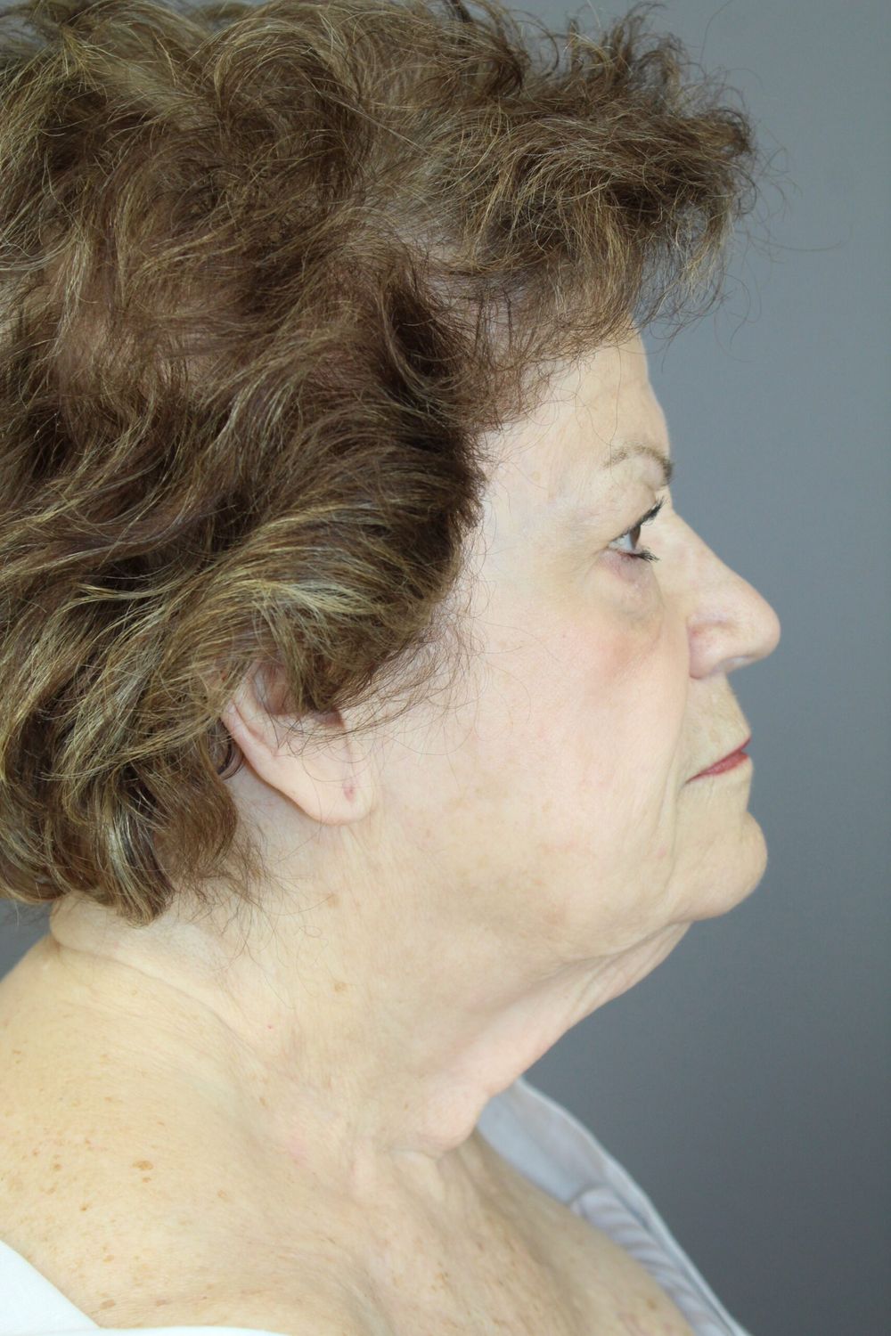 Face Lift Before & After