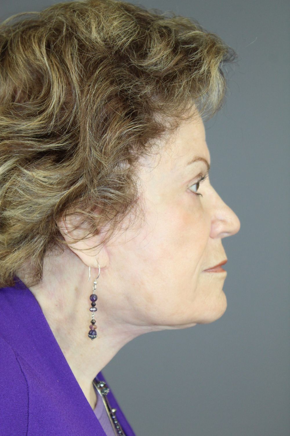 Face Lift Before & After