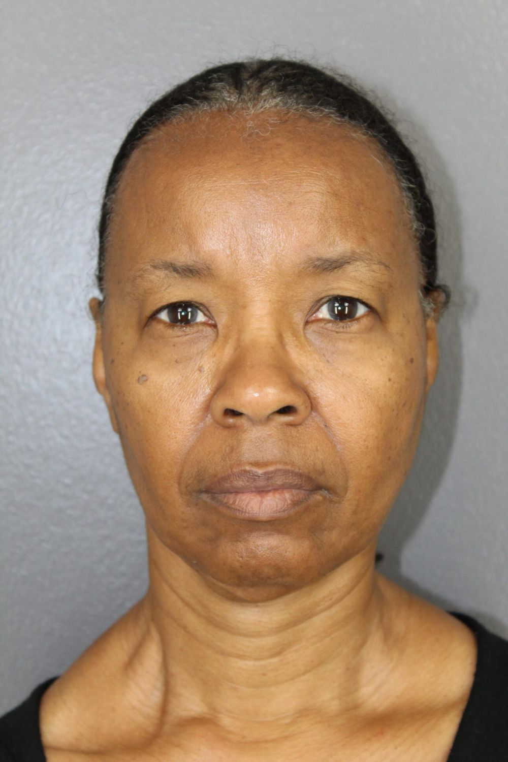 Face Lift Before & After