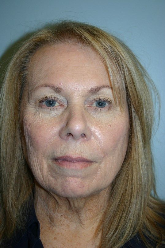Face Lift Before & After