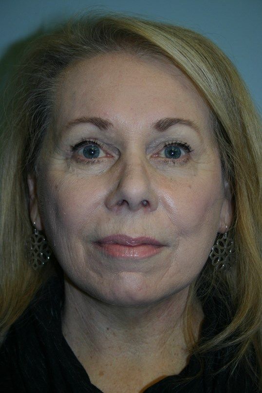 Face Lift Before & After