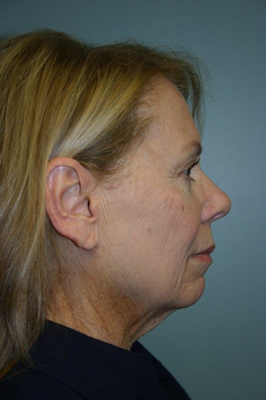 Face Lift Before & After