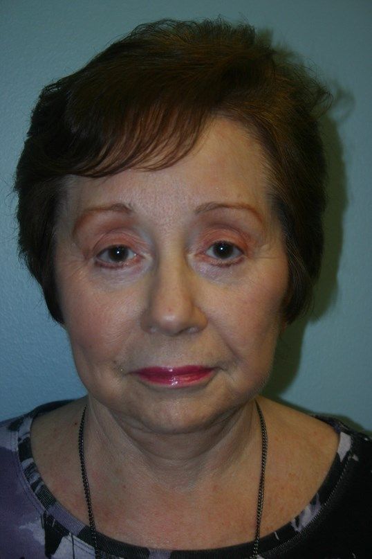 Face Lift Before & After