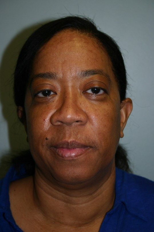 Face Lift Before & After