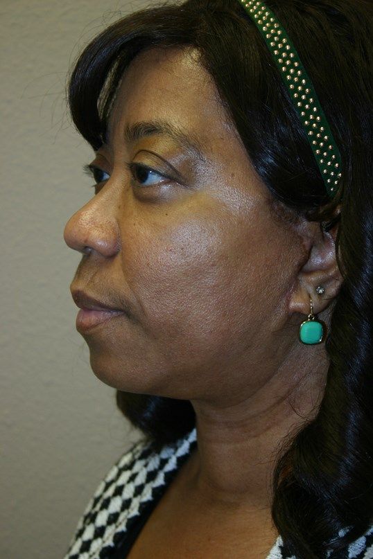 Face Lift Before & After