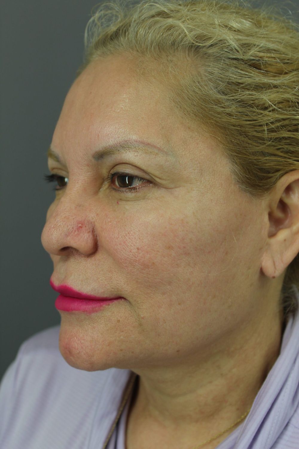 Face Lift Before & After