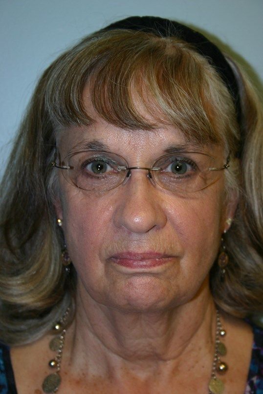 Face Lift Before & After