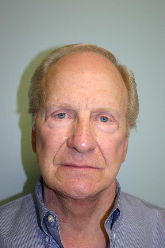 Face Lift Before & After