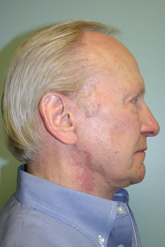 Face Lift Before & After